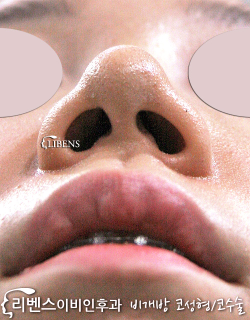 비대칭 콧구멍 매부리코 메부리코 수술 교정 성형 무보형물 여자 성형 s412